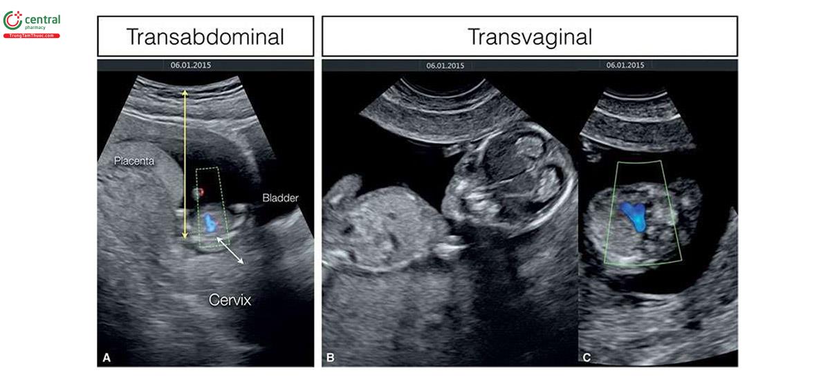 Hình 3.3: A: Một thai nhi 12 tuần tuổi được siêu âm qua ngả bụng với Doppler màu ở mặt cắt ba mạch máu-khí quản. Lưu ý, hình ảnh có độ phân giải thấp, chủ yếu do khoảng cách xa giữa đầu dò và vùng cần khảo sát; trong trường hợp này là ngực trên của thai nhi (mũi tên màu vàng). Cũng lưu ý, thai nhi nằm sâu trong tiểu khung và gần cổ tử cung (mũi tên màu trắng). B: Hình ảnh siêu âm qua ngả âm đạo cho thấy thai nhi nằm ngang, tư thế lý tưởng để siêu âm qua ngả âm đạo. C: Siêu âm qua ngả âm đạo với Doppler màu ở mặt cắt ba mạch máu-khí quản cho thấy hình ảnh có độ phân giải cao hơn so với cách tiếp cận qua ngả bụng ở A. Mặt cắt B và C thu được ở cùng một thai nhi ở mặt cắt A.