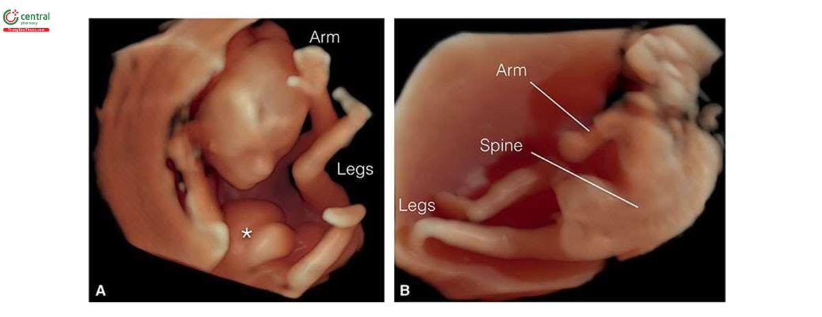 Hình 3.30: Hình ảnh siêu âm 3D ở chế độ bề mặt ở thai nhi 13 tuần tuổi bị bất thường phức hợp cơ thể (body stalk anomaly) nhìn từ phía trước (A) và phía sau (B). Ở hình A và B, thấy khiếm khuyết thành bụng (dấu hoa thị) và dị tật cơ thể và cột sống thai nhi. Trong những trường hợp như này, siêu âm 3D là phương thức hình ảnh tối ưu giúp hiển thị rõ ràng mức độ dị tật của thai nhi. So sánh với giải phẫu bình thường ở hình 3.25.
