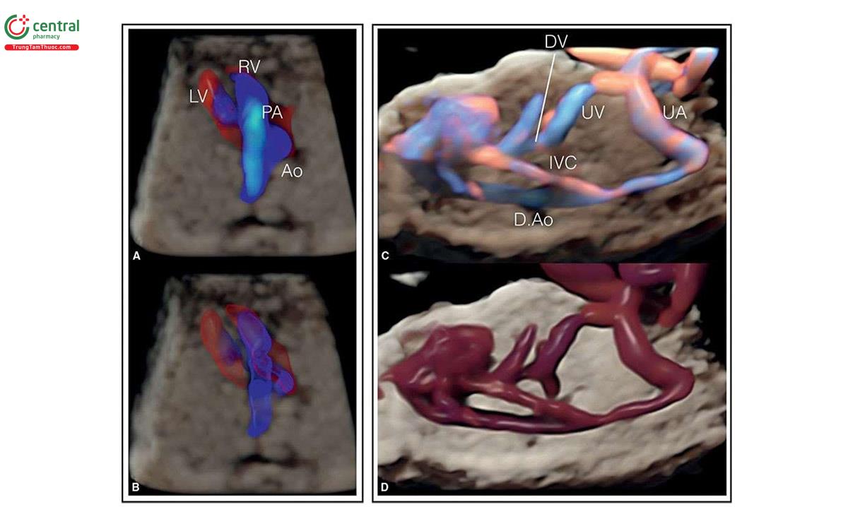 Hình 3.31: Hình trên bên trái (A) là hình ảnh siêu âm 3D tim thai với Doppler màu ở thai nhi 12 tuần tuổi. Hình dưới bên trái (B) cùng một khối 3D như ở A được hiển thị ở "glass-body mode + transparency”. Hình trên bên phải (C) là hình ảnh siêu âm 3D bụng thai nhi + Doppler màu độ nét cao + glass-body mode ở thai nhi 12 tuần tuổi. Hình dưới bên phải (D) cùng một khối 3D với Doppler một chiều (unidirectional Doppler flow). Hình trên (C) và dưới (D) bên phải cho thấy mối tương quan giải phẫu trong không gian của động mạch chủ xuống (D.Ao), tĩnh mạch rốn (UV), động mạch rốn (UA), tĩnh mạch chủ dưới (IVC) và ống tĩnh mạch (DV). RV, tâm thất phải; LV, tâm thất trái; Ao, động mạch chủ; PA, động mạch phổi.