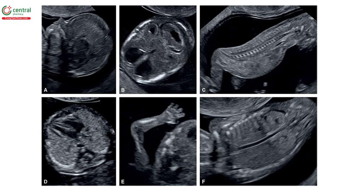 Hình 3.4: Các mặt cắt khác nhau (A-F) thu được bằng đầu dò độ phân giải cao qua ngả âm đạo ở thai nhi từ 11 đến 13 tuần tuổi. So sánh với Hình 3.1 và 3.2. Mặt cắt A là mặt cắt dọc giữa đầu thai nhi. Mặt cắt B cho thấy các cấu trúc nội sọ. Mặt cắt C là mặt cắt dọc giữa cột sống. Mặt cắt D là mặt cắt bốn buồng tim thai. Mặt cắt E cho thấy bàn tay và các ngón tay thai nhi và mặt cắt F là mặt cắt vành của ngực và bụng cho thấy thận thai nhi. Lưu ý, các hình ảnh này có độ phân giải cao hơn so với các hình ảnh trong Hình 3.1 và 3.2.