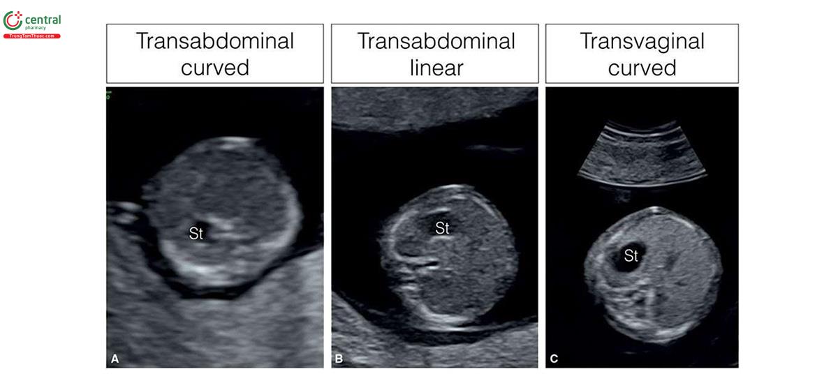 Hình 3.5: Mặt cắt ngang bụng thai nhi 12 tuần tuổi ở 3 thai nhi (A-C) sử dụng 3 đầu dò độ phân giải cao khác nhau: A - đầu dò cong qua ngả bụng, B - đầu dò phẳng qua ngả bụng, và C - đầu dò âm đạo. Lưu ý, hình ảnh có độ phân giải cao hơn ở mặt cắt B và C. St, dạ dày.