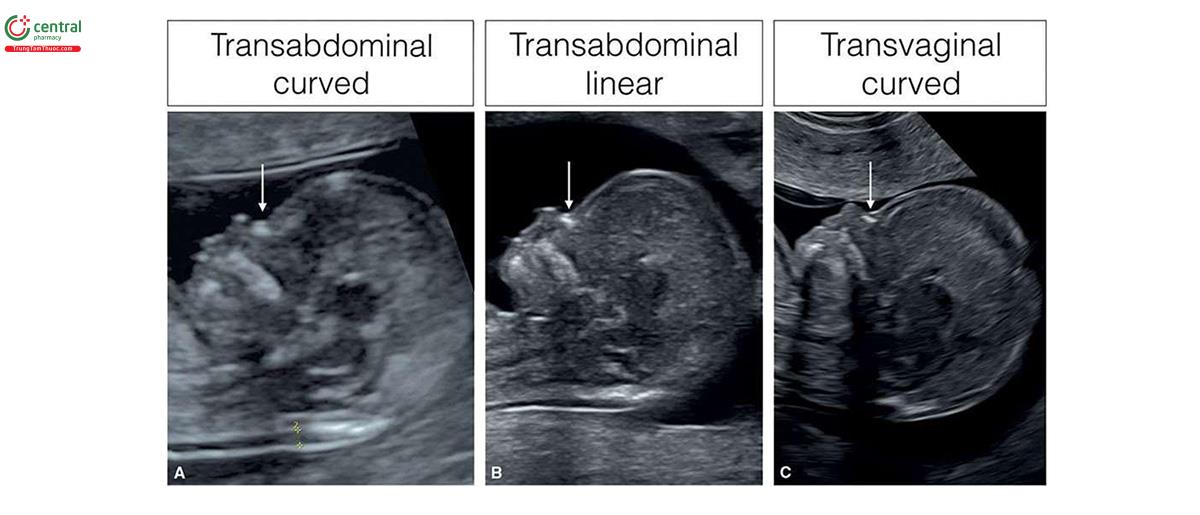 Hình 3.6: Mặt cắt dọc giữa ở 3 thai nhi từ 12 đến 13 tuần tuổi, thu được bằng 3 đầu dò độ phân giải cao khác nhau: A - đầu dò cong qua ngả bụng, B - đầu dò phẳng qua ngả bụng và C - đầu dò âm đạo. Lưu ý, ở C hình ảnh có độ phân giải cao hơn so với A và B. Cũng lưu ý, xương mũi (mũi tên) có đường viền sắc nét ở B và C, so với đường viền mờ ở A. Khi nghi ngờ dị tật thai nhi, cách tiếp cận qua ngả âm đạo giúp đánh giá giải phẫu thai nhi chi tiết hơn ở tuổi thai nhỏ.