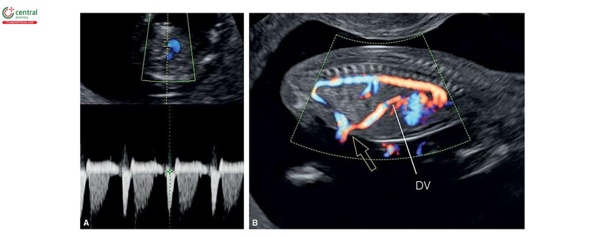 Hình 3.7: A: Mặt cắt ngang ngực thai nhi 13 tuần tuổi với Doppler xung trên tim để chứng minh và ghi lại hoạt động tim thai. Các tác giả không khuyến nghị điều này vì Doppler xung mang năng lượng cao tập trung tại một vị trí, và nên dùng M-mode hoặc lưu một đoạn phim siêu âm 2D cho mục đích này (xem Chương 2). Khi Doppler màu được chỉ định, hộp màu trên thai nhi (B) có thể ghi lại hoạt động tim thai và cho thấy thành bụng trước nguyên vẹn (mũi tên) và ống tĩnh mạch có đường đi bình thường (DV).