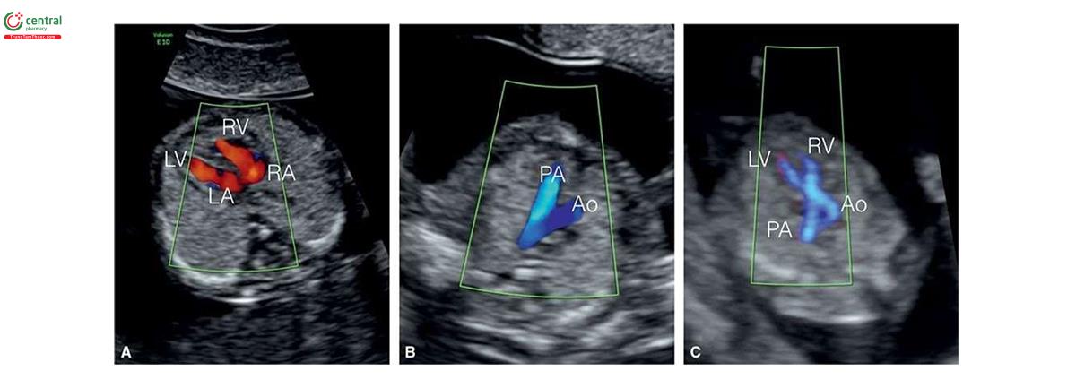 Hình 3.8: Hình ảnh tim thai ở tuổi thai 11 đến 13 tuần, được siêu âm với Doppler màu. A: Dòng chảy tâm trương từ cả nhĩ phải (RA) và trái (LA) tương ứng vào thất phải (RV) và trái (LV). B: Mặt cắt ba mạch máu-khí quản bình thường với động mạch chủ (Ao) và động mạch phổi (PA). C: Mặt cắt chếch (oblique view) cho thấy cả đường ra thất trái và phải trong thì tâm thu với Ao và PA bắt chéo nhau (crossing).