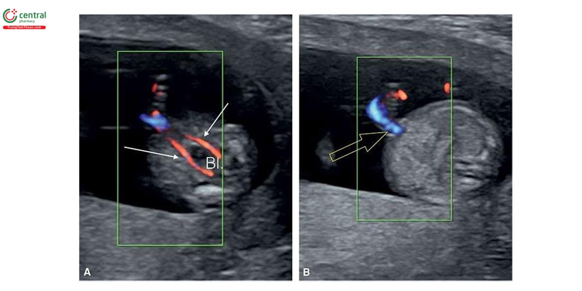 Hình 3.9: Mặt cắt ngang tiểu khung (A) và bụng giữa (B) với Doppler màu ở thai nhi 13 tuần tuổi, sử dụng đầu dò phẳng độ phân giải cao. Lưu ý, 2 động mạch rốn (mũi tên) bao quanh bàng quang (Bl.) ở A và thành bụng nguyên vẹn (mũi tên rỗng) ở B. So sánh với hình 3.10.