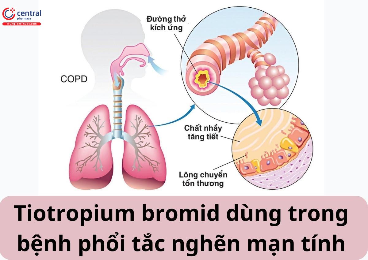 Chỉ định của Tiotropium bromid