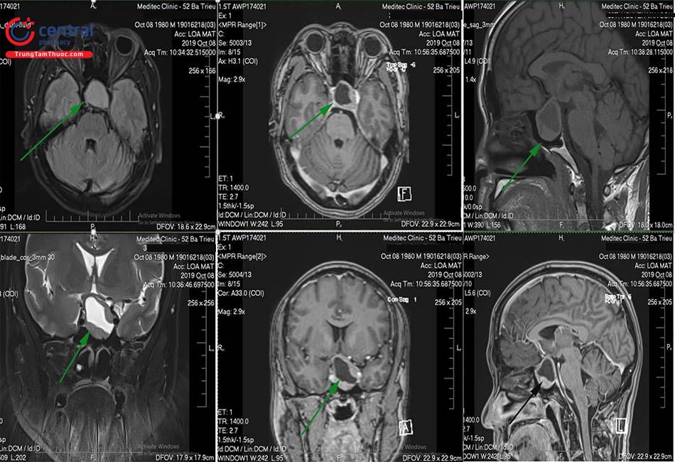 Hình ảnh cộng hưởng từ (MRI) tuyến yên 