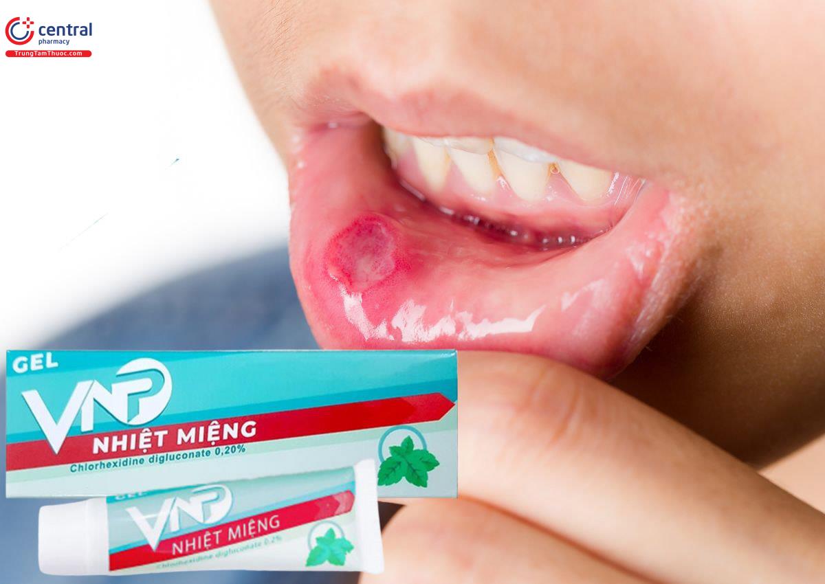 Gel VNP Nhiệt Miệng giúp giảm nhiệt miệng, viêm lợi