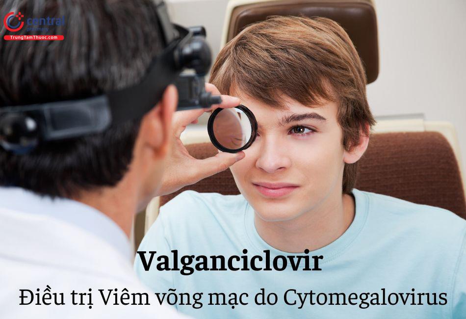 Valganciclovir điều trị viêm võng mạc do Cytomegalovirus