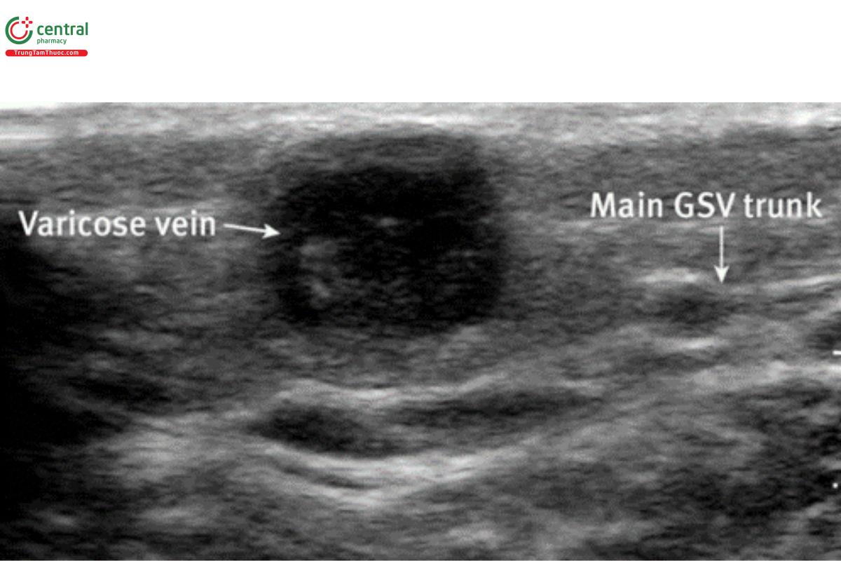 Viêm tắc huyết khối tĩnh mạch nông (Nasr và cộng sự)