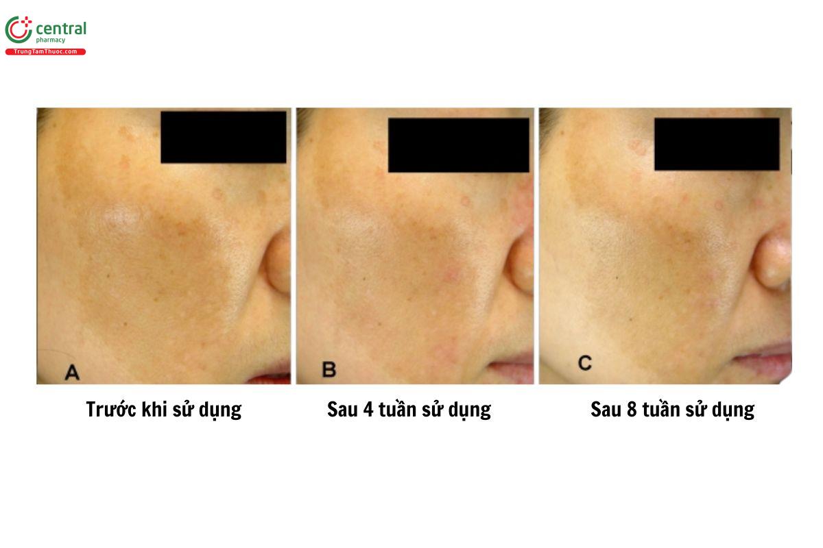 Đánh giá hiệu quả điều trị nám của Whitenol