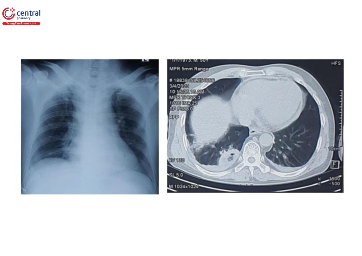 Hình 1. Xquang ngực và CT scan ngực của bệnh nhân 