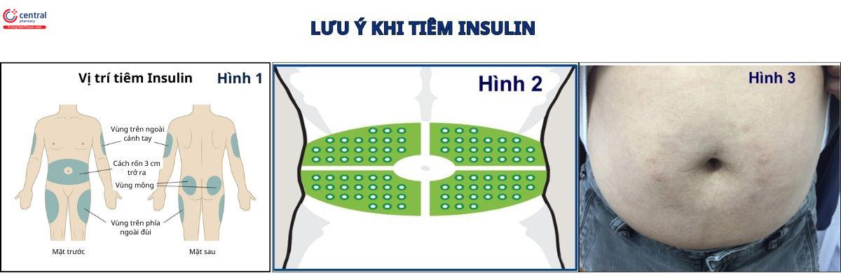 Lưu ý về vị trí tiêm Insulin