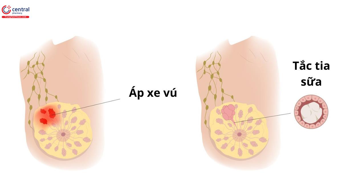 Áp xe vú và tắc tia sữa