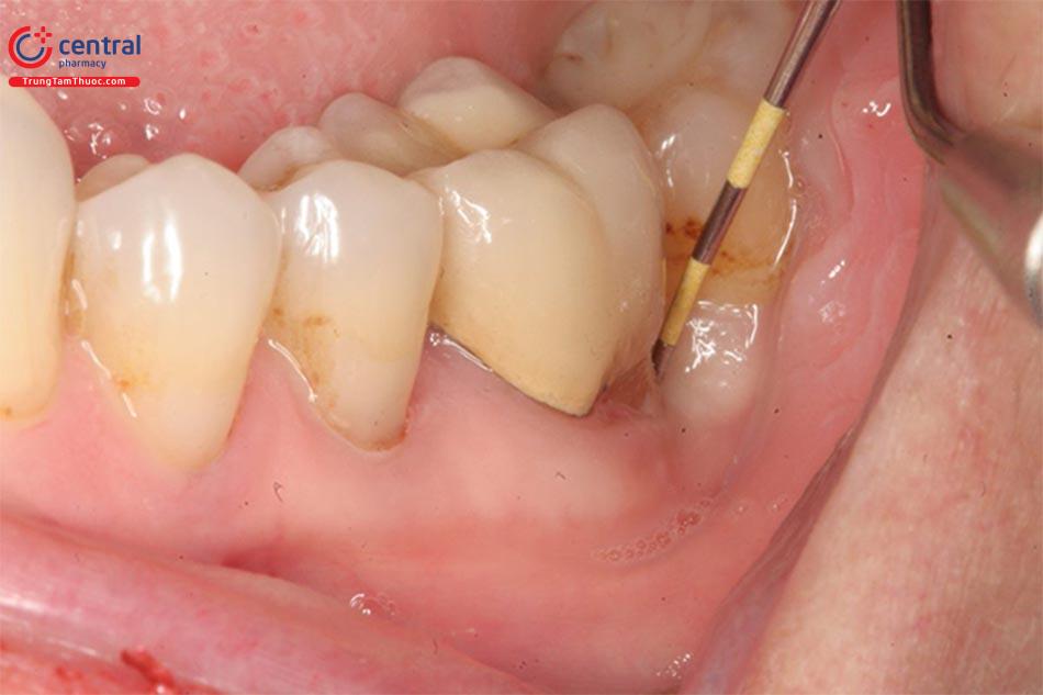 Điều trị áp xe răng