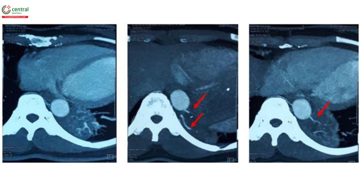 Hình 2. Hình ảnh CLVT 128 dãy thời điểm bệnh nhân tái khám: Tổn thương dạng đám mờ thùy dưới phổi trái, động  mạch cấp máu bắt nguồn từ động mạch chủ ngực (mũi tên)
