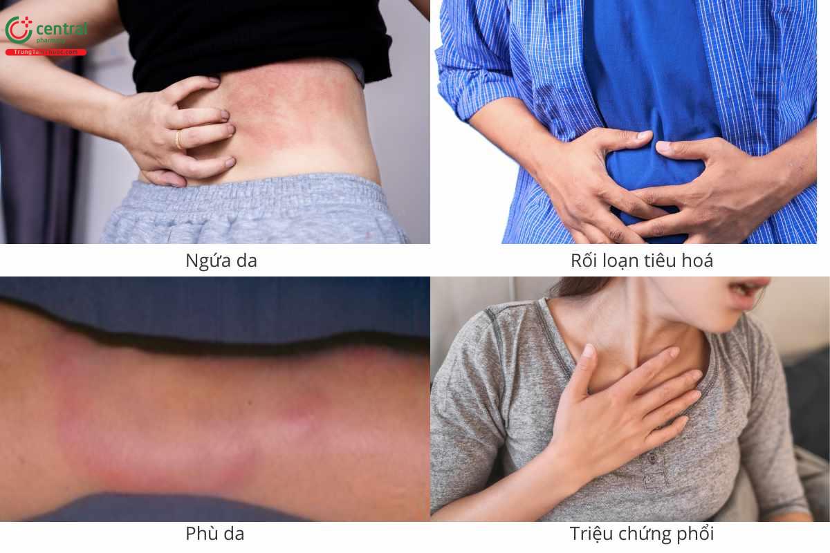 Triệu chứng nhiễm giun đầu gai