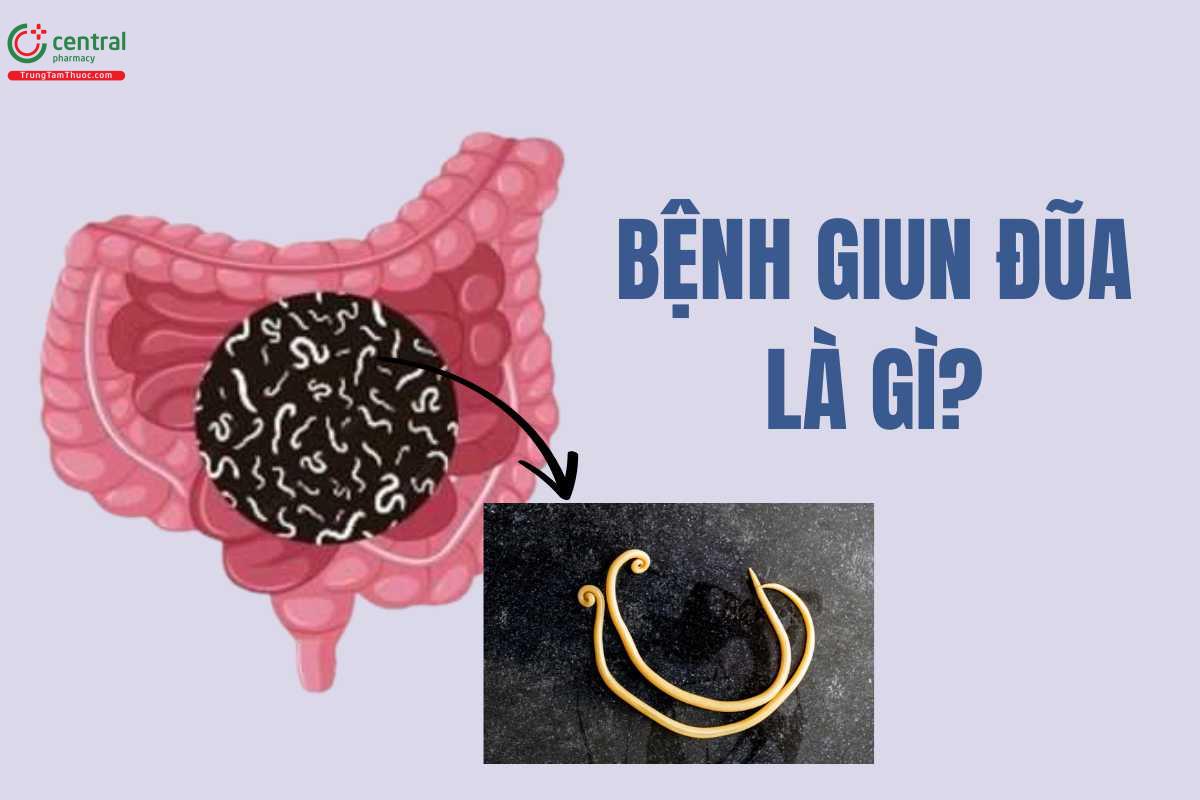 Bệnh giun đũa (Ascaris lumbricoides) là gì?