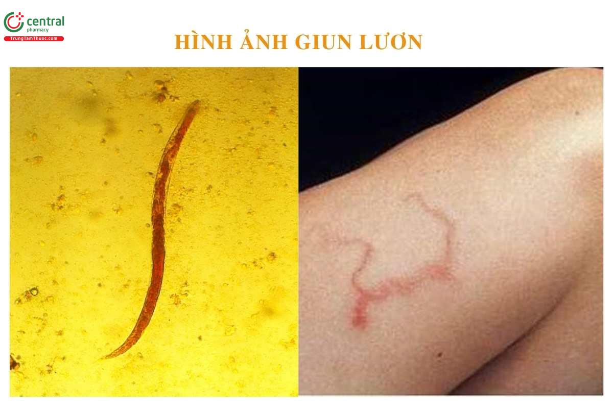 Hình ảnh giun lươn dưới kính hiển vi và trên da người