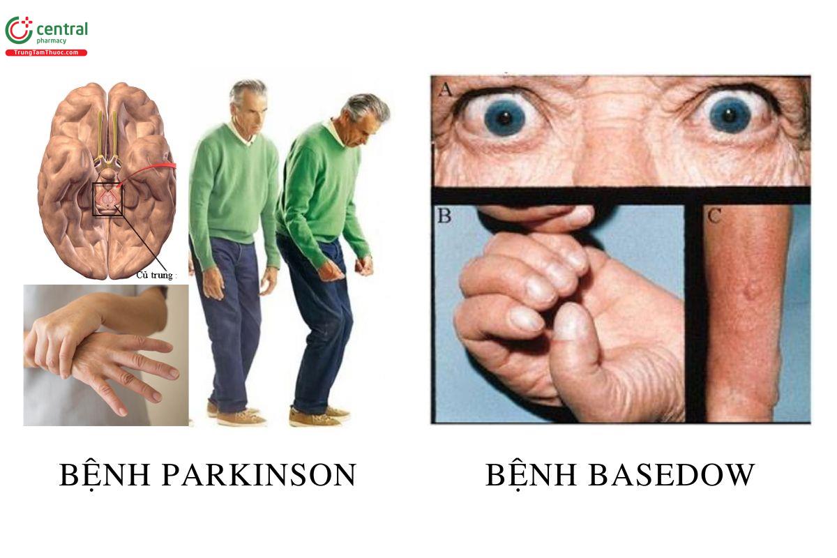 Phân biệt bệnh Parkinson và bệnh Basedow