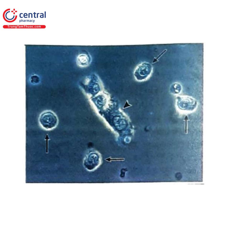 Hình 12. Trụ tế bào biểu mô ống thận. Hình này cho thấy các tế bào ống thận (mũi tên) được tìm thấy trong nước tiểu, cùng với một mảnh của trụ tế bào biểu mô ống thận (đầu mũi tên). Các tế bảo hình ống được đặc trưng bởi một nhân trung tâm và nhiều hạt tế bào chất. Nguồn: Michael RR