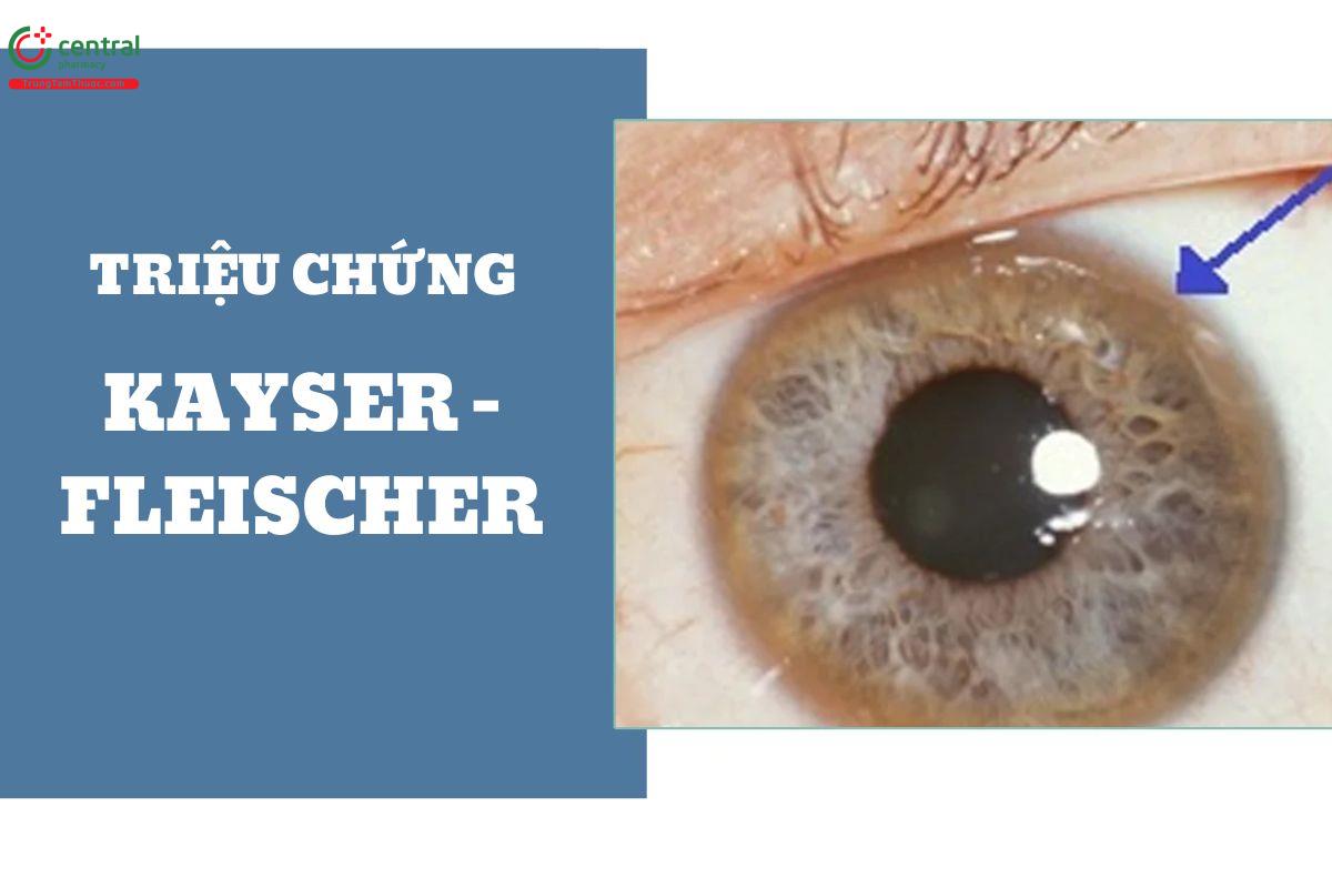 Triệu chứng vòng Kayser - Fleischer 