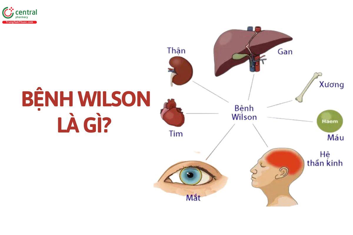 Bệnh Wilson là gì?