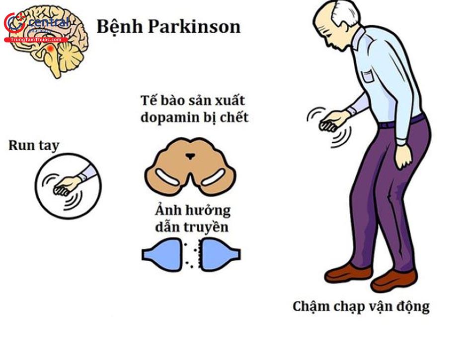 Biểu hiện của bệnh Parkinson