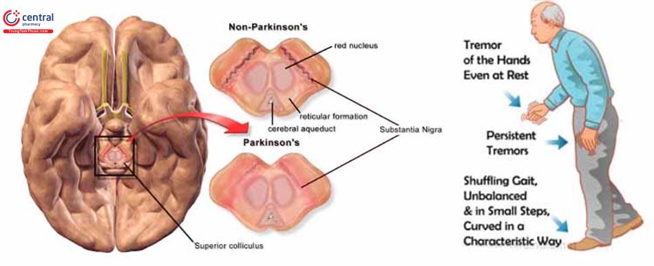 Hình ảnh các biểu hiện của bệnh Parkinson