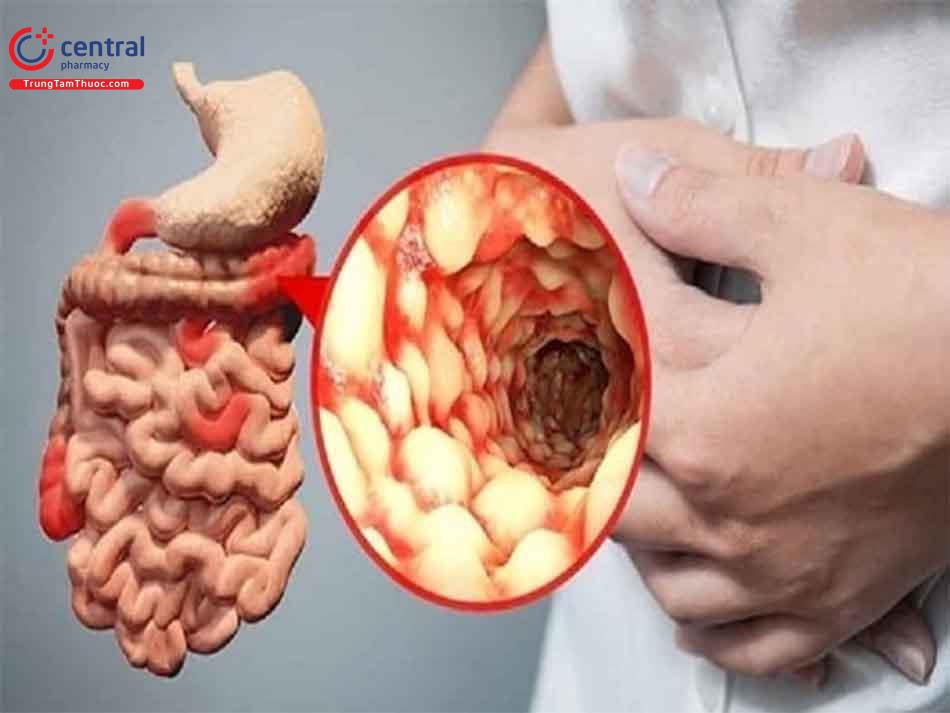 Hình ảnh bệnh Crohn