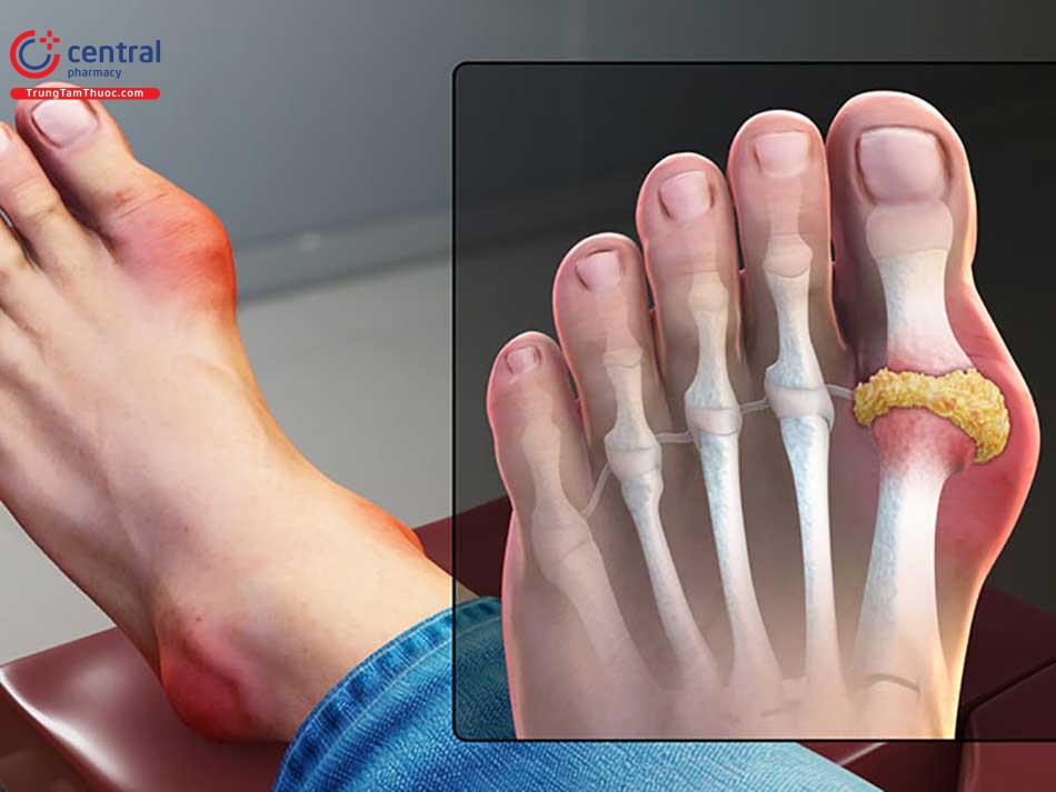 Bệnh gout là gì?