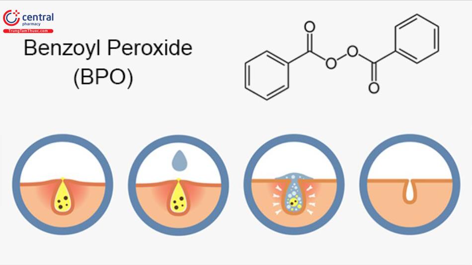 Benzoyl Peroxide có tác dụng trị mụn hiệu quả và an toàn?