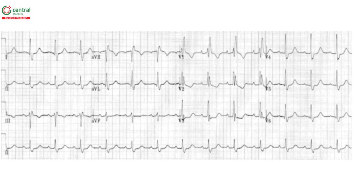 Hình 4. ECG của RBBB lành tính