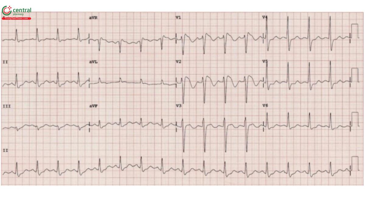 Hình 5. Dạng Brugada típ 1 - QRS có thể bình thường hoặc chỉ kéo dài nhẹ (không rộng như blốc nhánh phải điển hình). Thay vì sóng rSR' rõ ràng, sóng R' cuối có dạng "lõm" hoặc "hình yên ngựa" kèm theo đoạn ST chênh lên, đoạn ST chênh lên dạng lõm >2 mm ở >1 trong các V1-V3, tiếp theo là sóng T âm.