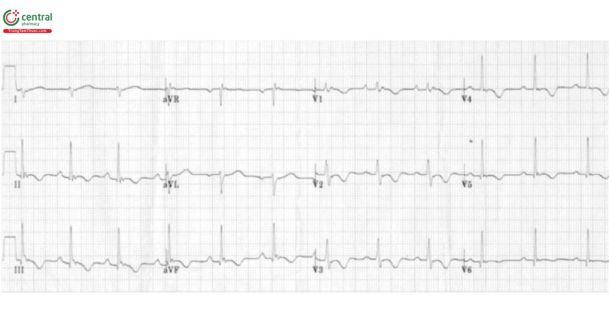 Hình 6. ARVD - Loạn sản thất phải gây rối loạn nhịp tim - Giãn rộng cục bộ phức hợp QRS ở V1-2, dạng giống blốc nhánh phải không hoàn toàn, nhưng sóng R' cuối thường có biên độ thấp và không sắc nét như blốc nhánh phải điển hình, sóng Epsilon (độ lệch dương nhỏ ở cuối phức hợp QRS trong V1-V3) là dấu hiệu đặc trưng của ARVC. Đảo ngược sóng T sâu ở V1-V3 (đôi khi lan đến V4-V5) khi không có blốc nhánh phải hoàn toàn là một tiêu chí chẩn đoán quan trọng.