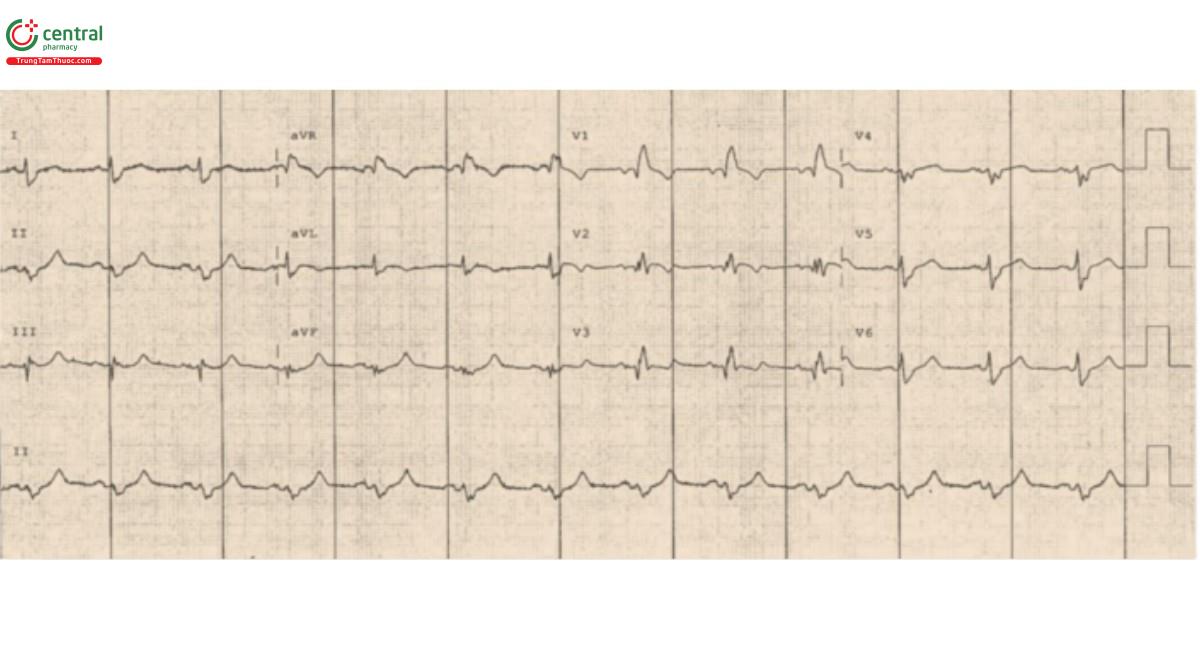 Hình 7. Điện tâm đồ cho thấy blốc nhánh phải (RBBB) + lệch trục trái (LAFB - Bifascicular Block), và có ST chênh lên đồng thời ở chuyển đạo V2, tất cả đều gợi ý tắc nghẽn động mạch vành trái trước (LAD) đoạn gần.
