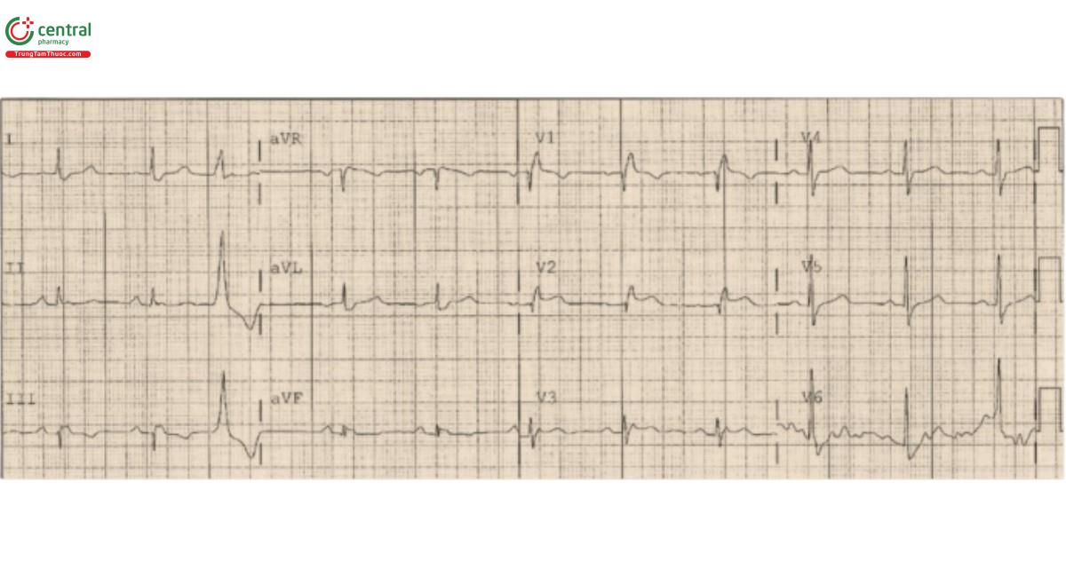 Hình 8. Điện tâm đồ cho thấy ST chênh lên ở V2 và V3 phù hợp với sóng R' với hình thái blốc nhánh phải (RBBB). Đây là tắc nghẽn động mạch vành trái trước cấp tính.
