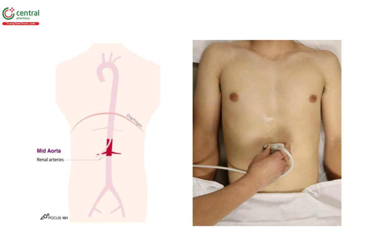Động mạch chủ bụng đoạn giữa và vị trí đầu dò để khảo sát động mạch chủ bụng đoạn giữa