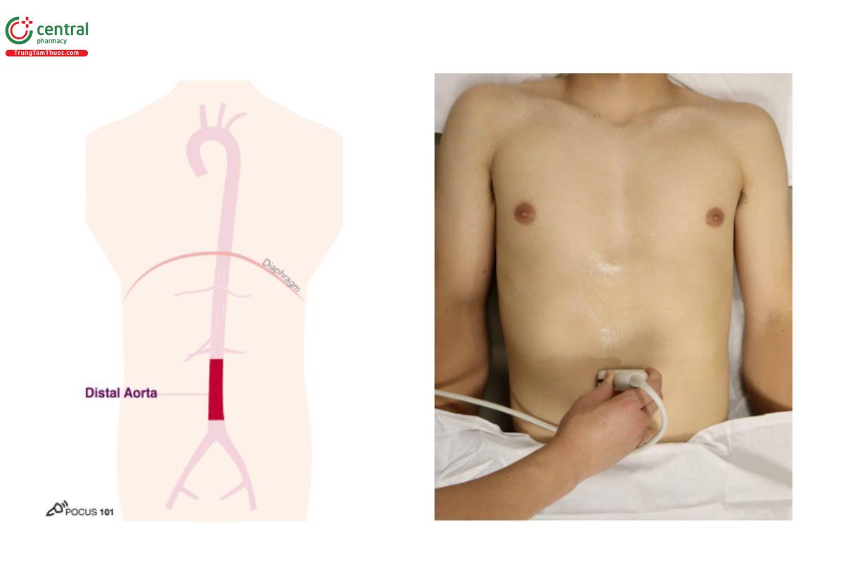 Động mạch chủ bụng đoạn xa và vị trí đặt đầu dò để khảo sát động mạch chủ bụng đoạn xa