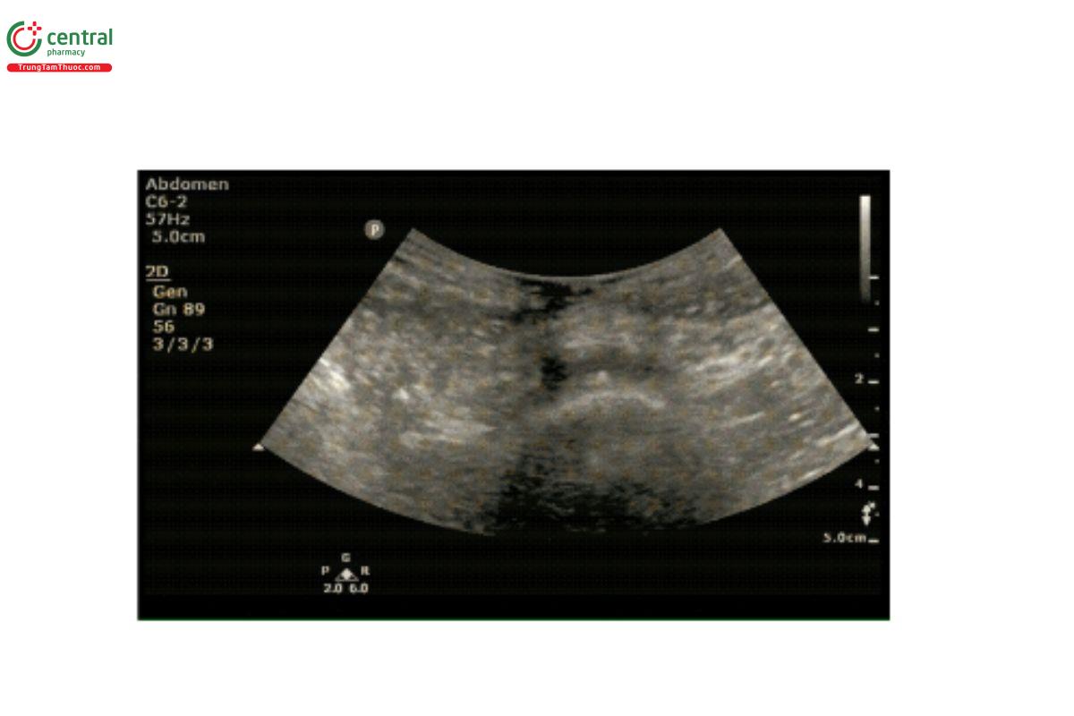 Động mạch chủ bụng chia đôi thành động mạch chậu phải và trái