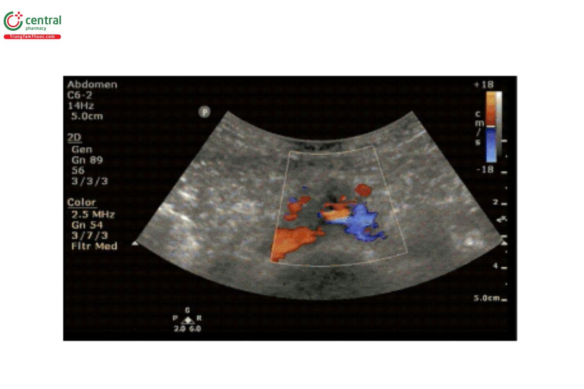 Doppler màu vị trí chia đôi