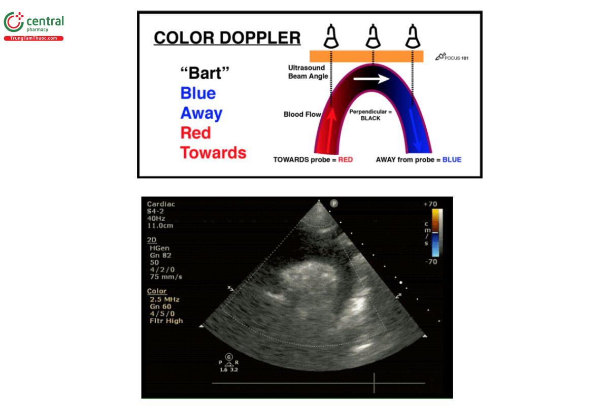 Mặt cắt hõm trên ức khi sử dụng Doppler màu