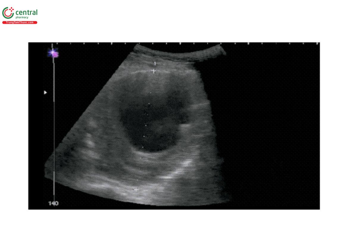 AAA hình thoi được thấy khi đường kính của động mạch chủ ≥ 3cm