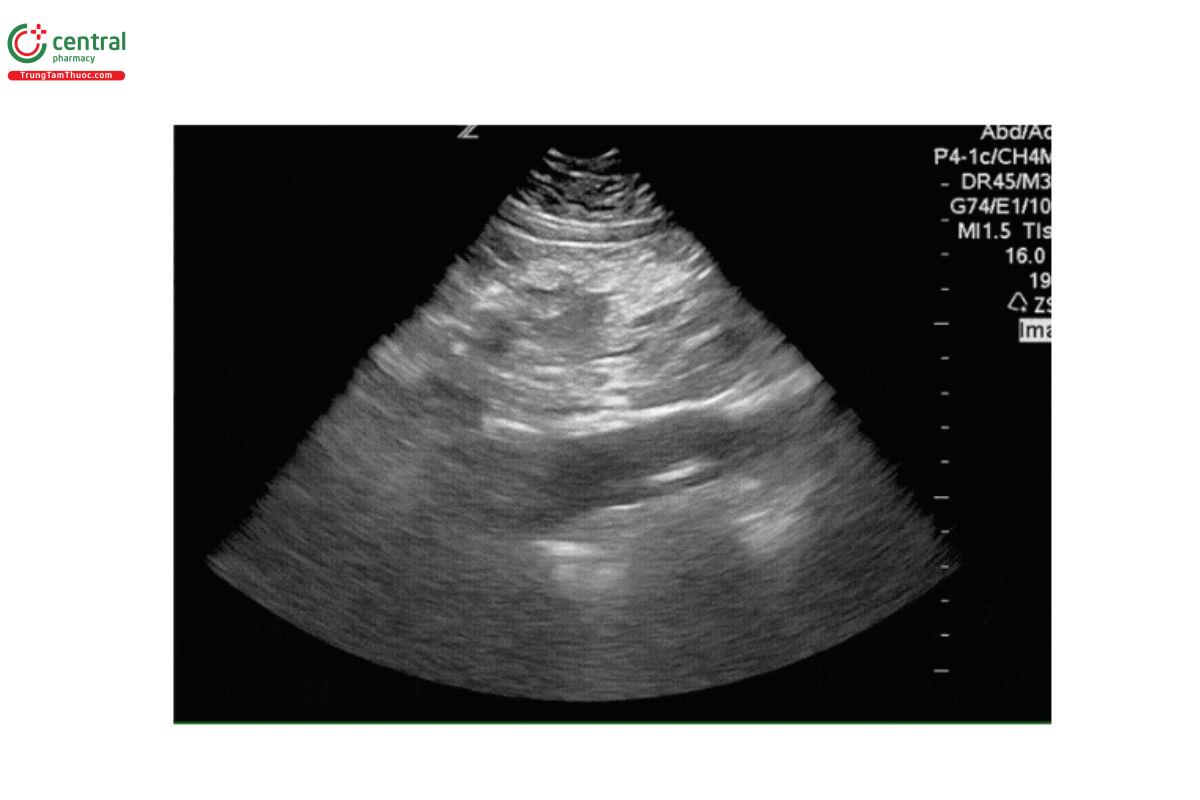 Một vạt nội mạc lớn trên mặt cắt dọc động mạch chủ xuống