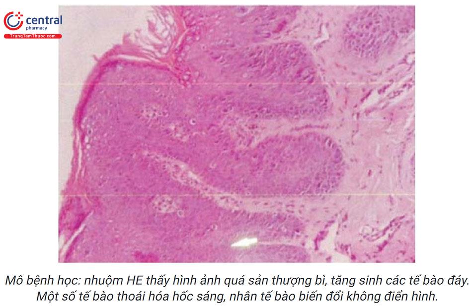 Các bệnh lý tiền ung thư, ung thư da và cách điều trị