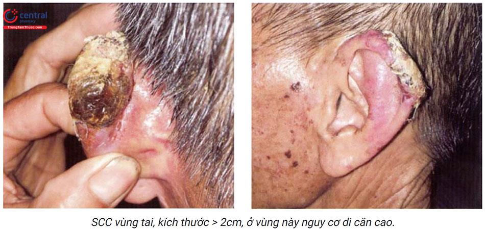 Các bệnh lý tiền ung thư, ung thư da và cách điều trị