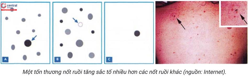 Các bệnh lý tiền ung thư, ung thư da và cách điều trị