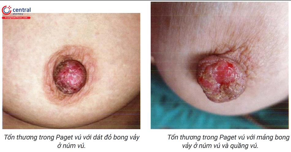 4. Phương pháp điều trị sùi mào gà ở núm vú