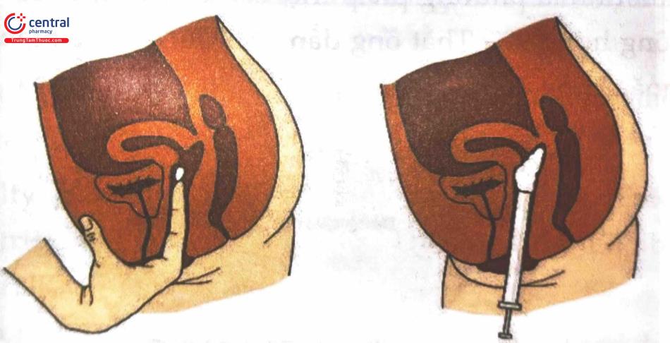 Hình 9. Thuốc diệt tinh trùng