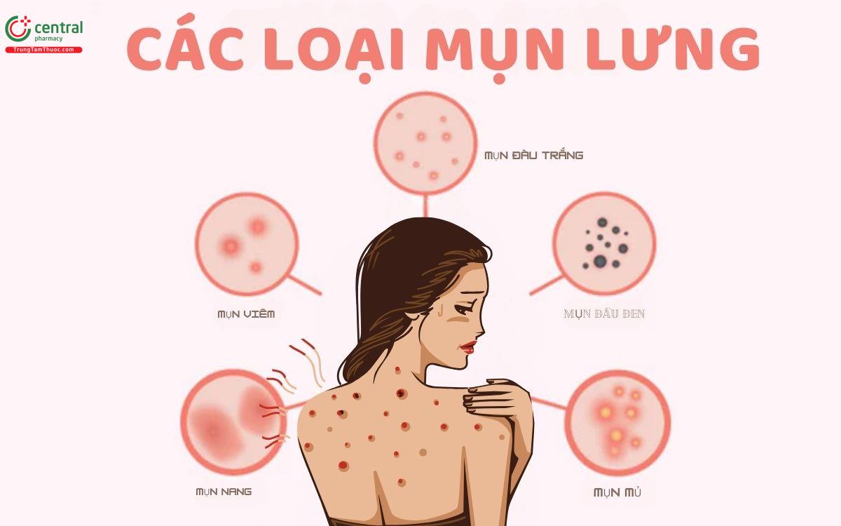 Các loại mụn lưng thường gặp